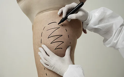 Endolifting en cadera y muslos