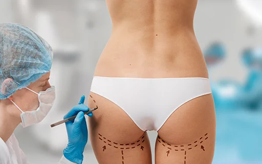 Endolifting en glúteos