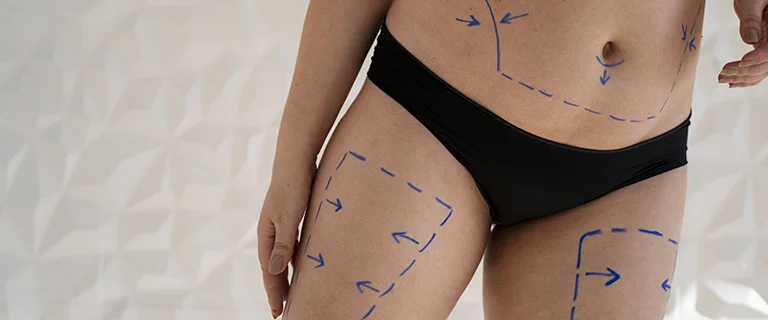 Endolifting en muslos